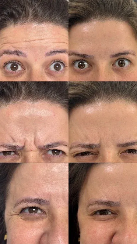 Antes e depois — toxina botulínica na testa