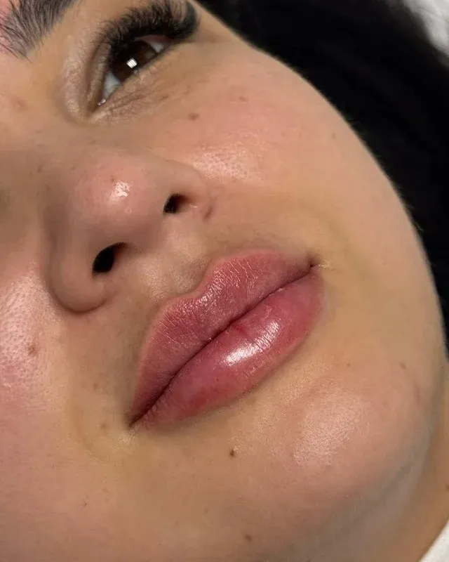 Depois - tratamento labial
