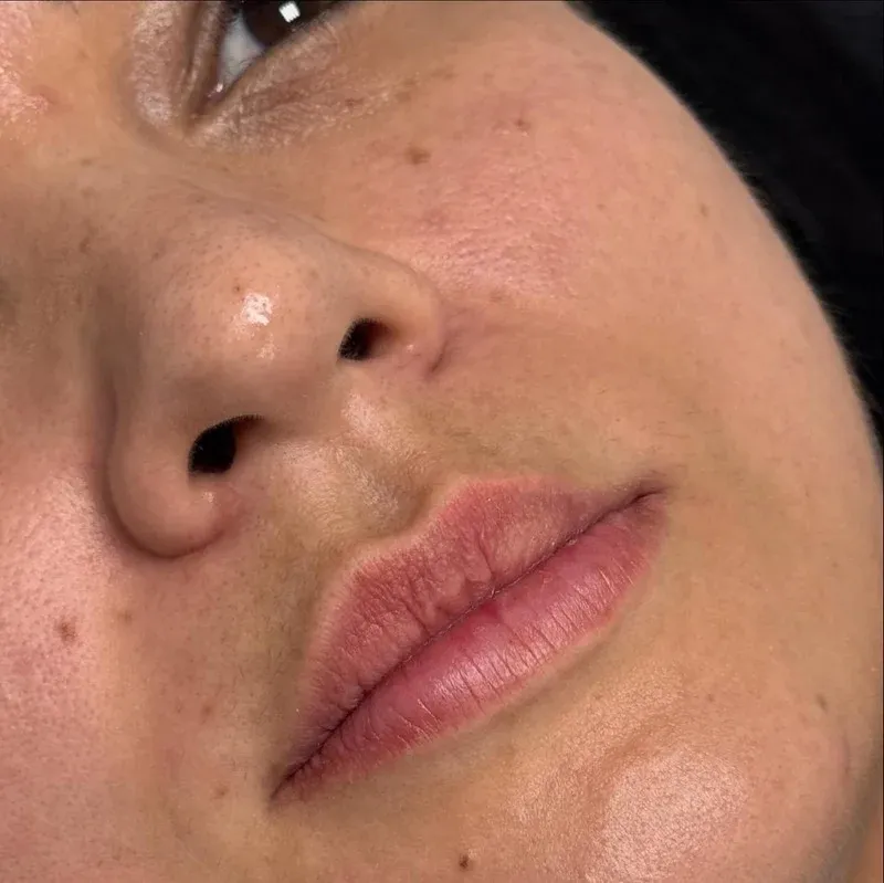 Antes - tratamento labial