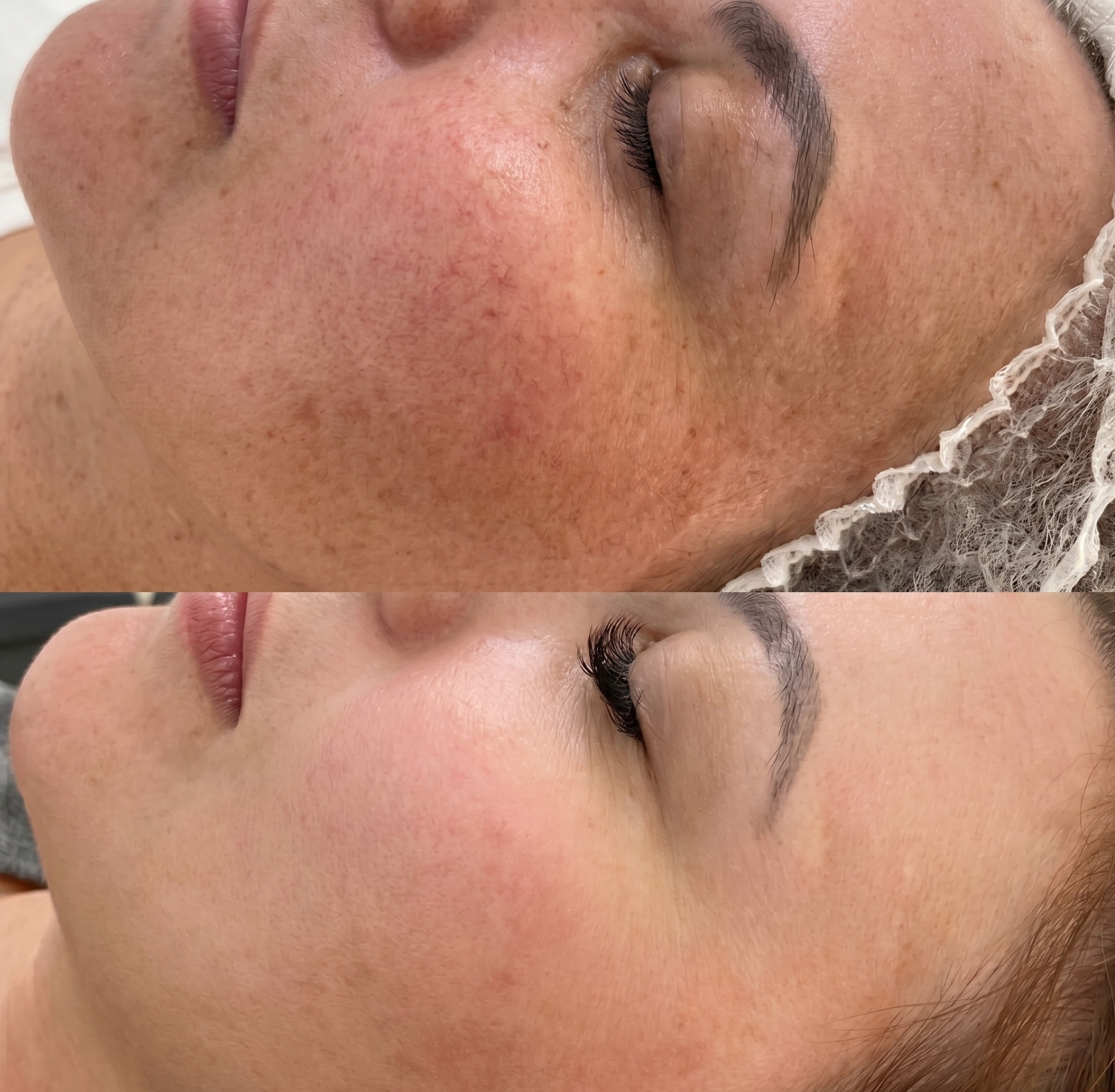 Antes e depois - tratamento de manchas