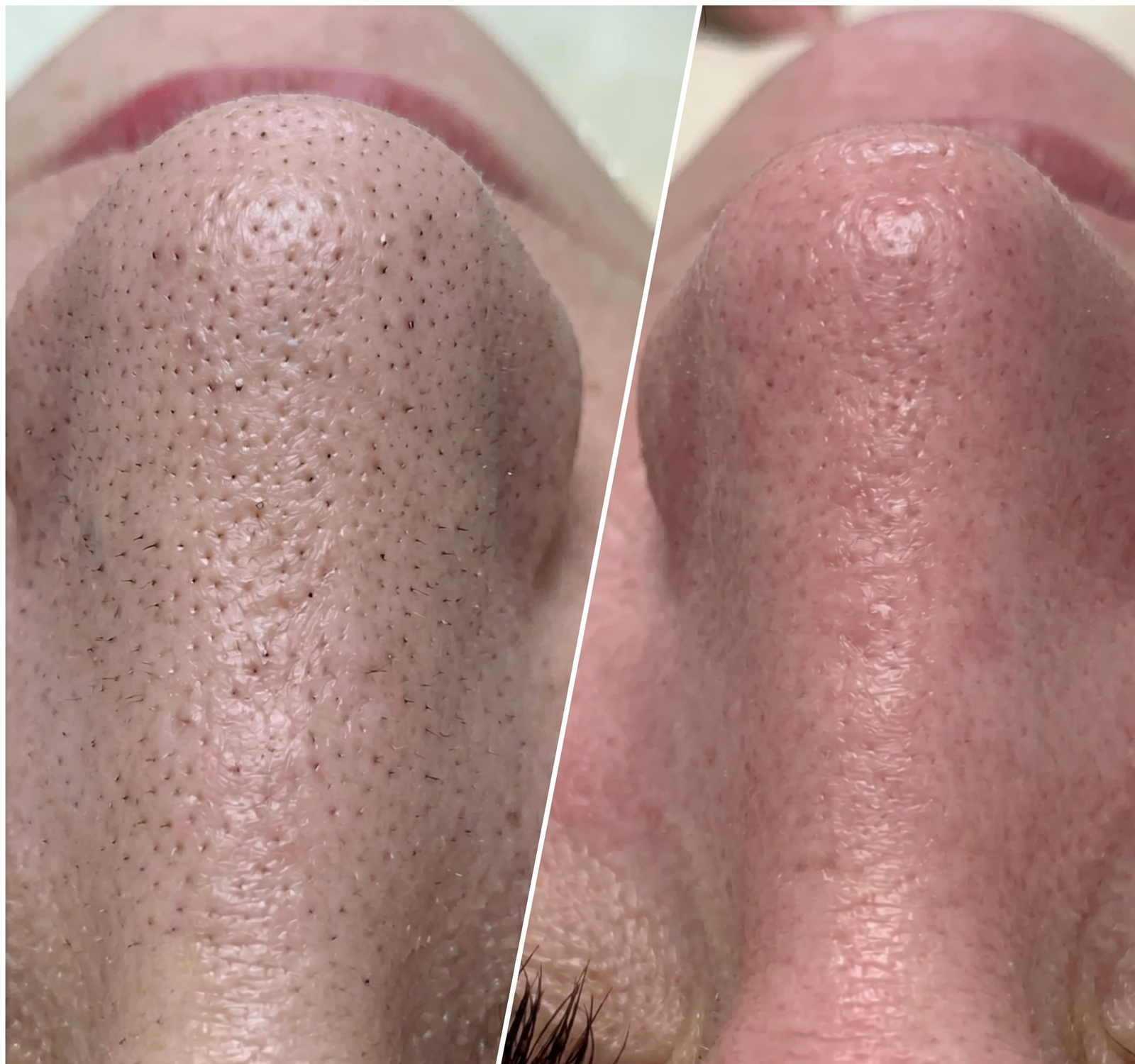 Antes e depois — peeling